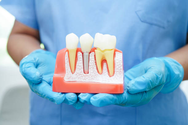 Restoring Confidence with Dental Implants in Belconnen